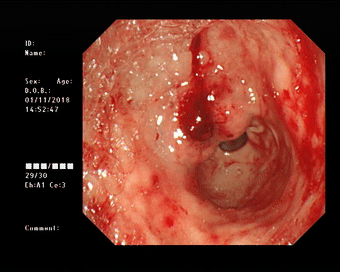 胃溃疡便血图片