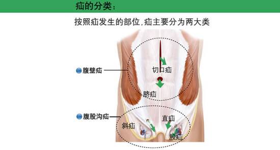 股疝手术步骤图片