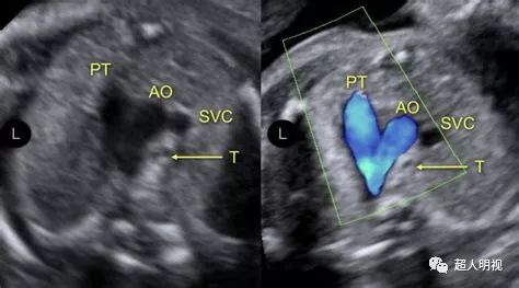 三尖瓣发育不良)主动脉横弓细 (左心发育不全综合征,严重主动脉狭窄
