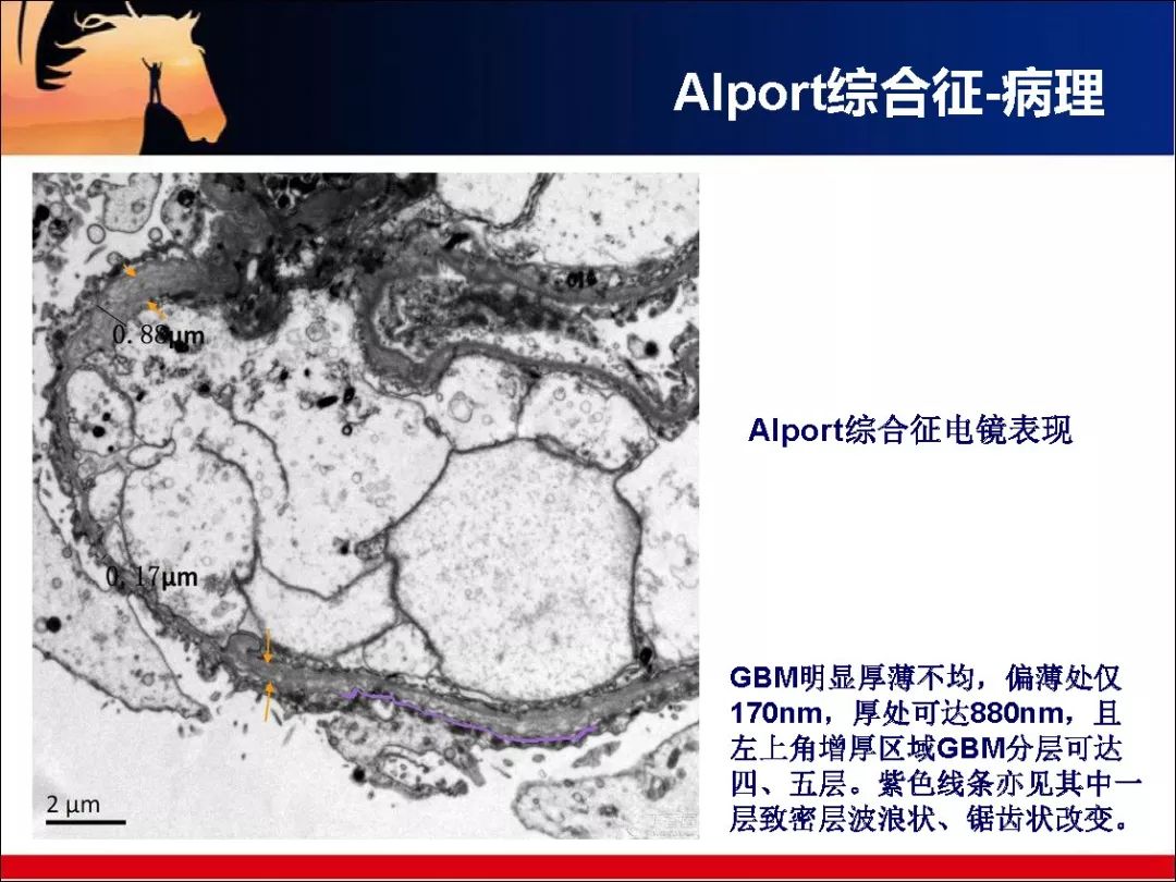 alport綜合徵與薄基底膜腎病這份幻燈值得看看