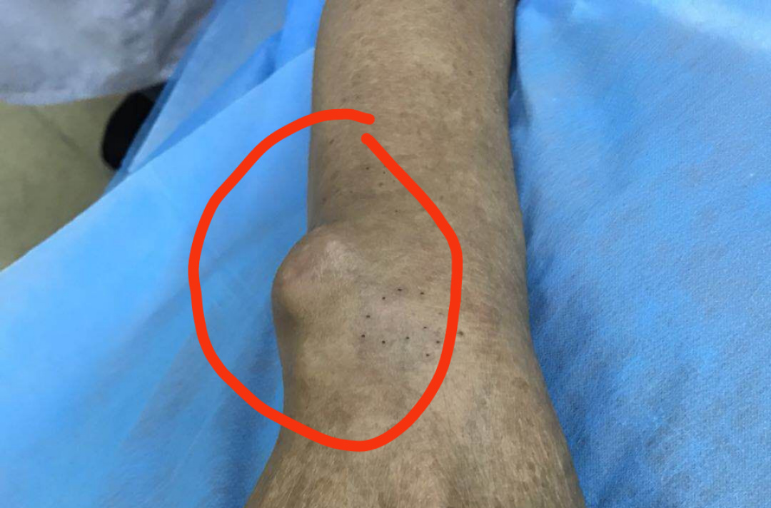 右侧肘关节有鸡蛋样大小痛风石,且患者右侧脚踝痛风石皮肤已经变薄,破