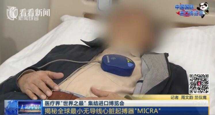 視頻進博會揭秘全球最小無導線心臟起搏器micra