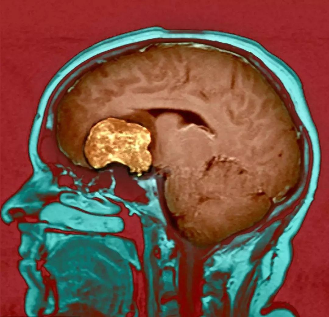 【微健康】专家说:出现以下症状必须引起高度警惕,有可能是脑肿瘤!