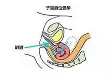 子宫后位受孕方法图片