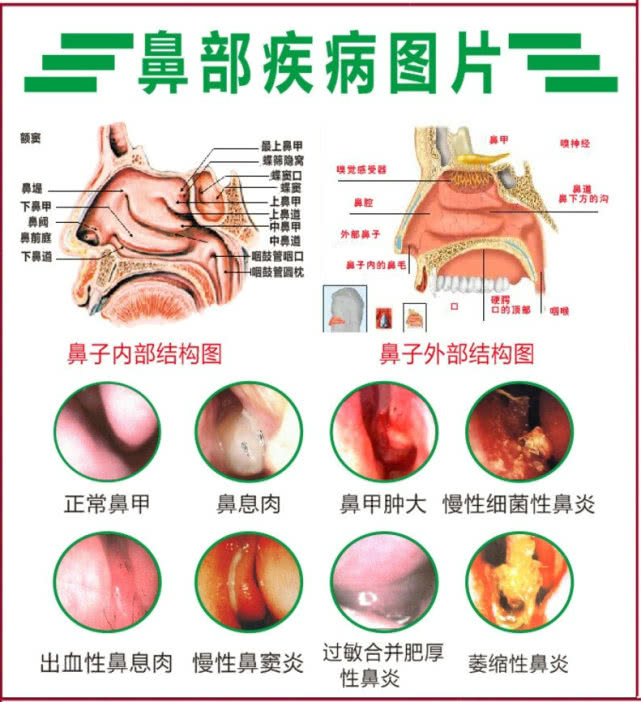 好鼻和鼻炎对比内部图图片