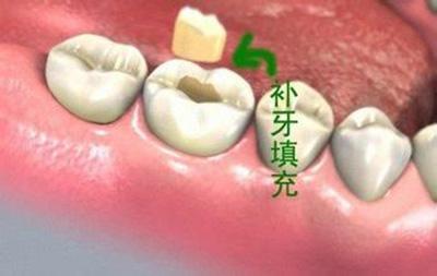 北京補牙材料怎樣選擇呢