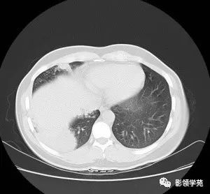 病例右肺下叶大片楔形实变影内见空泡征