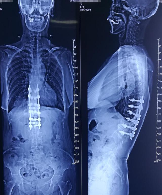 病例分享胸腰段脊柱后凸畸形
