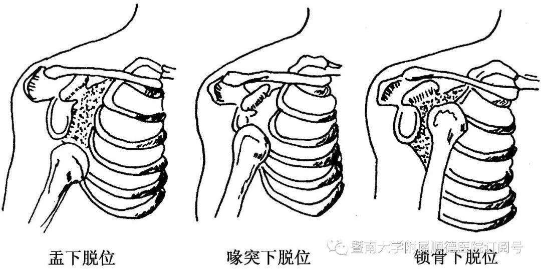 下颚撕裂器原理图片