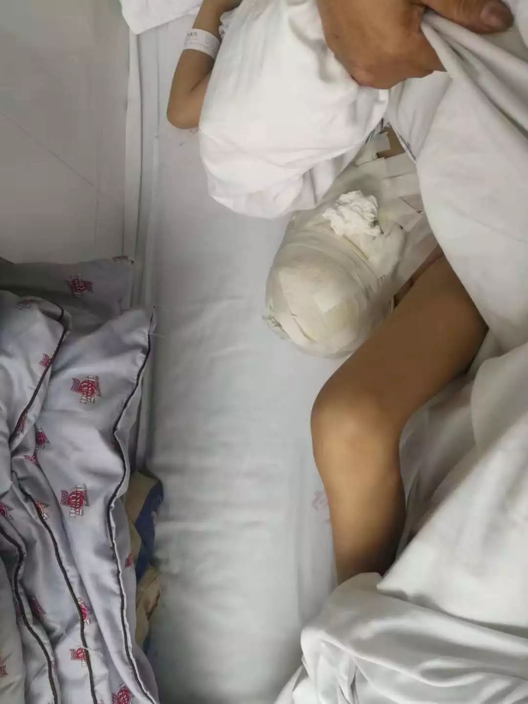 心疼徐医附院的这个女孩还是截肢了就在她过10岁生日的前一天
