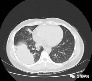 病例右肺下叶大片楔形实变影内见空泡征