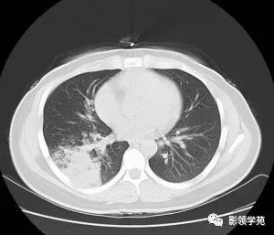 内见空泡征,未见支气管充气征及枯树枝征,病灶上部见斑片状磨玻璃阴影