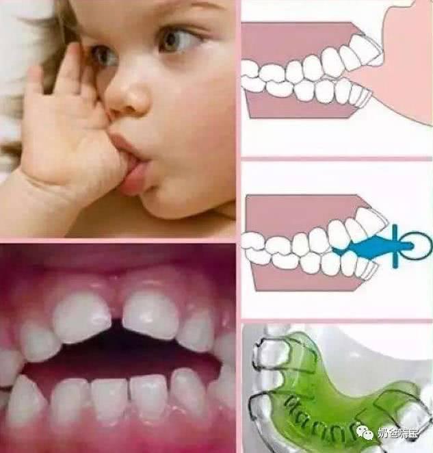 1,吃手,也许会让孩子变丑宝宝的小手长期浸泡在口水里,受到牙齿的压迫