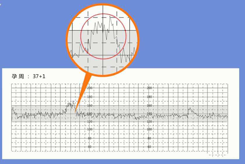 胎兒監護胎心監護報告解讀之胎心率曲線值該如何看