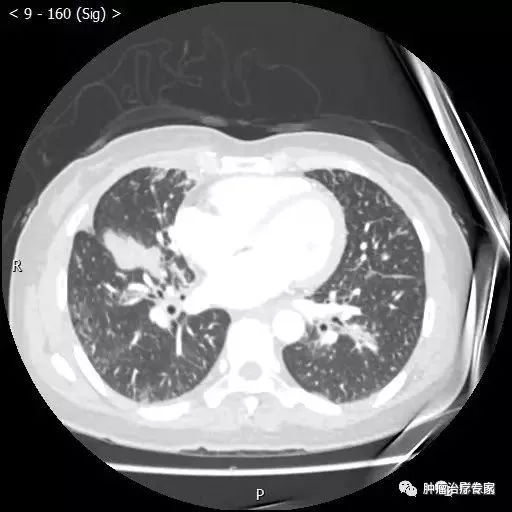 中央型肺癌一例