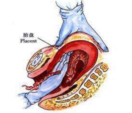 扯胎盘图片