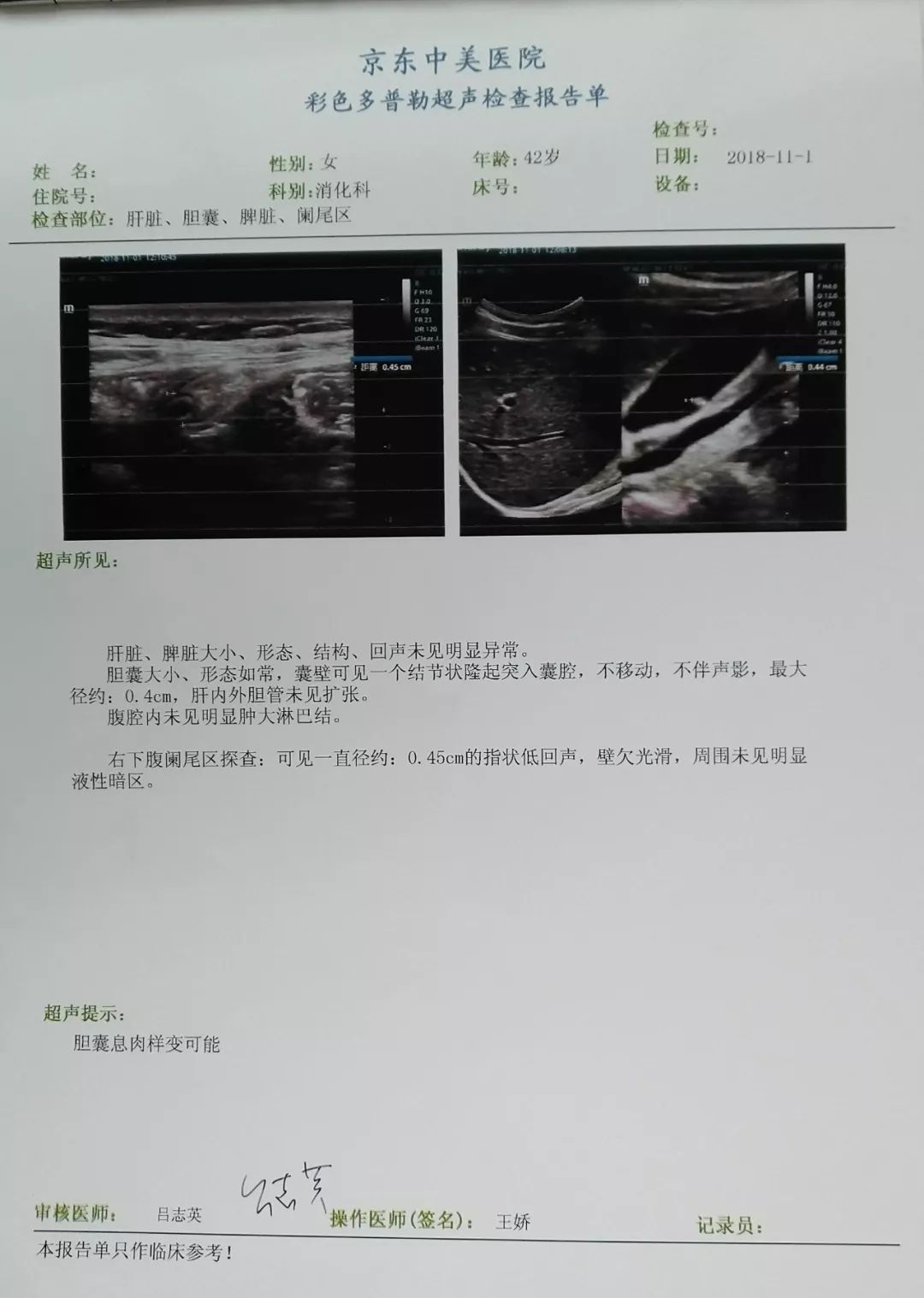 急性阑尾炎的彩超图片图片