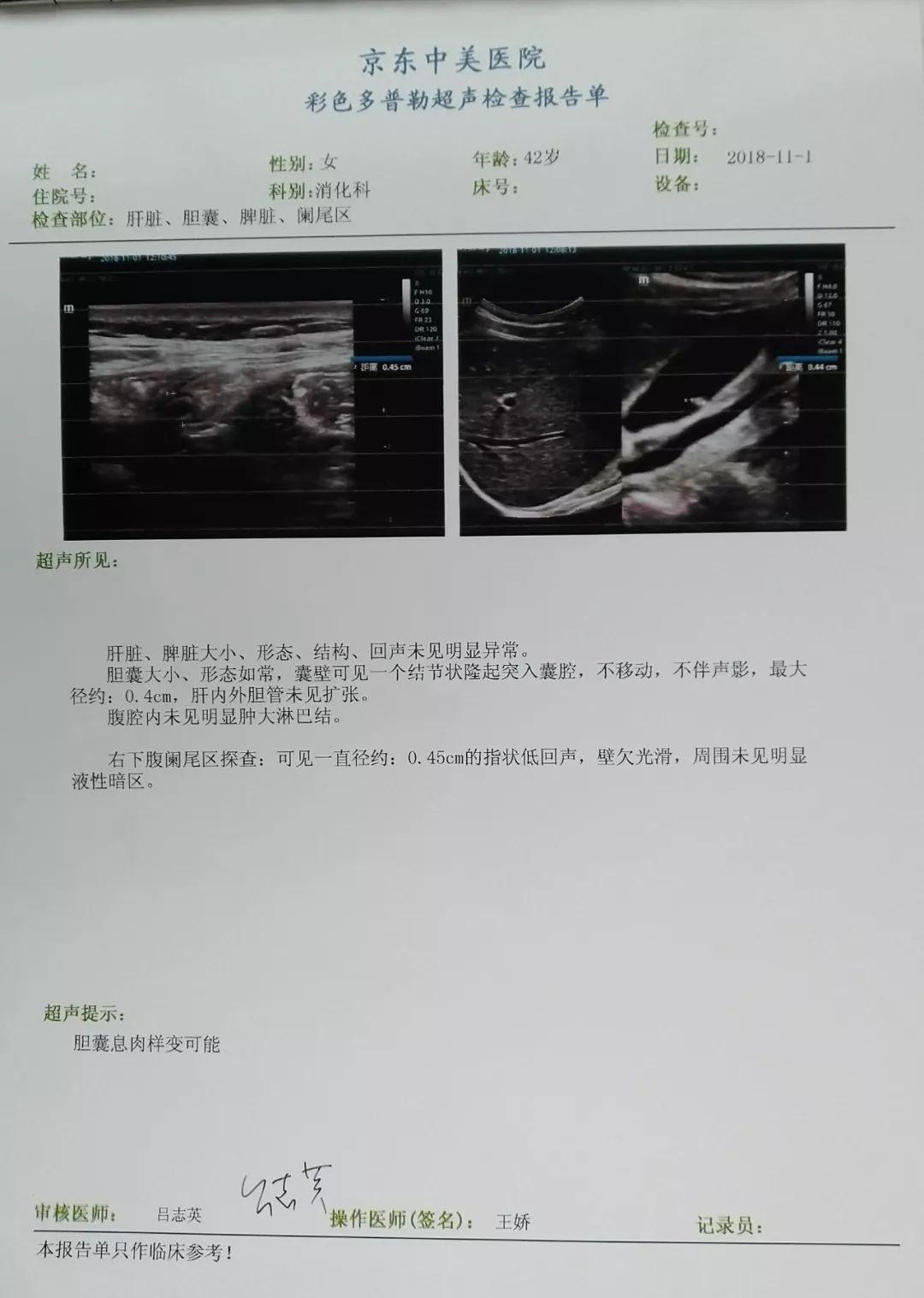 阑尾超声报告模板图片