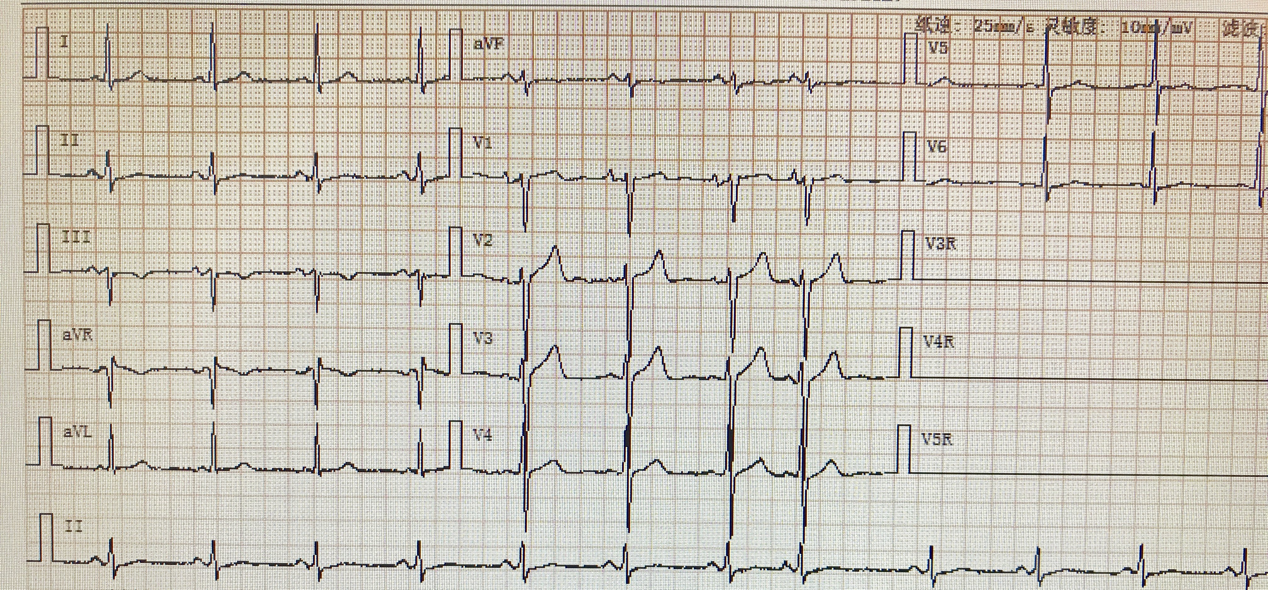 慢房颤心电图图片