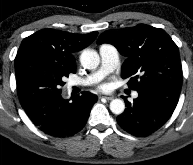 急性肺栓塞的肺ct血管造影