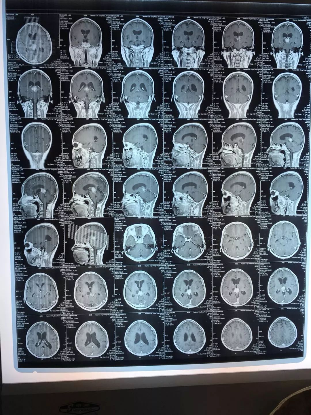 脑部肿瘤核磁共振照片图片