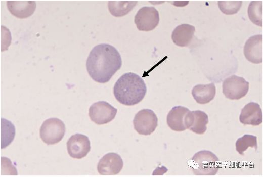 外周血,瑞氏染色嗜碱性点彩红细胞0620180306箭头所指细胞名称外周