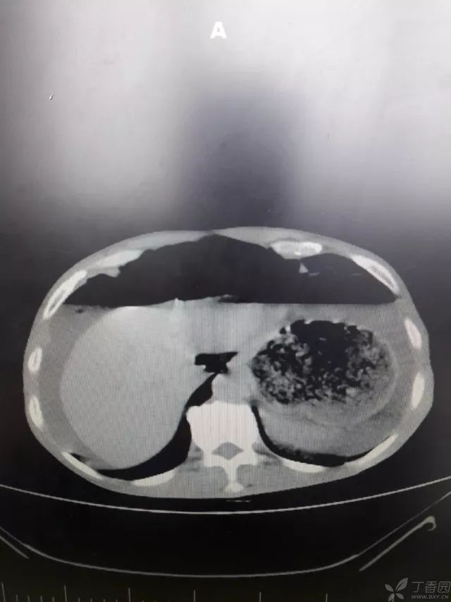 腹腔积液的ct表现图图片