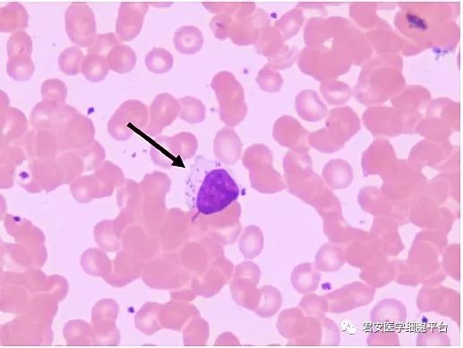 看图识细胞第35期2018年第1次北京市血细胞形态学室间质评