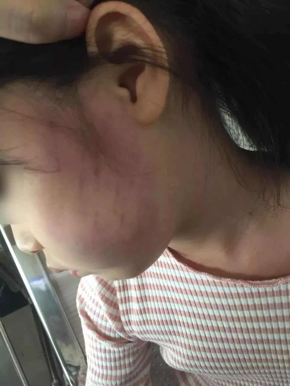 东莞某幼儿园出现虐童现象! 4岁女童遭扇掌一脸淤青