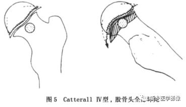 股骨頭骨骺缺血性壞死