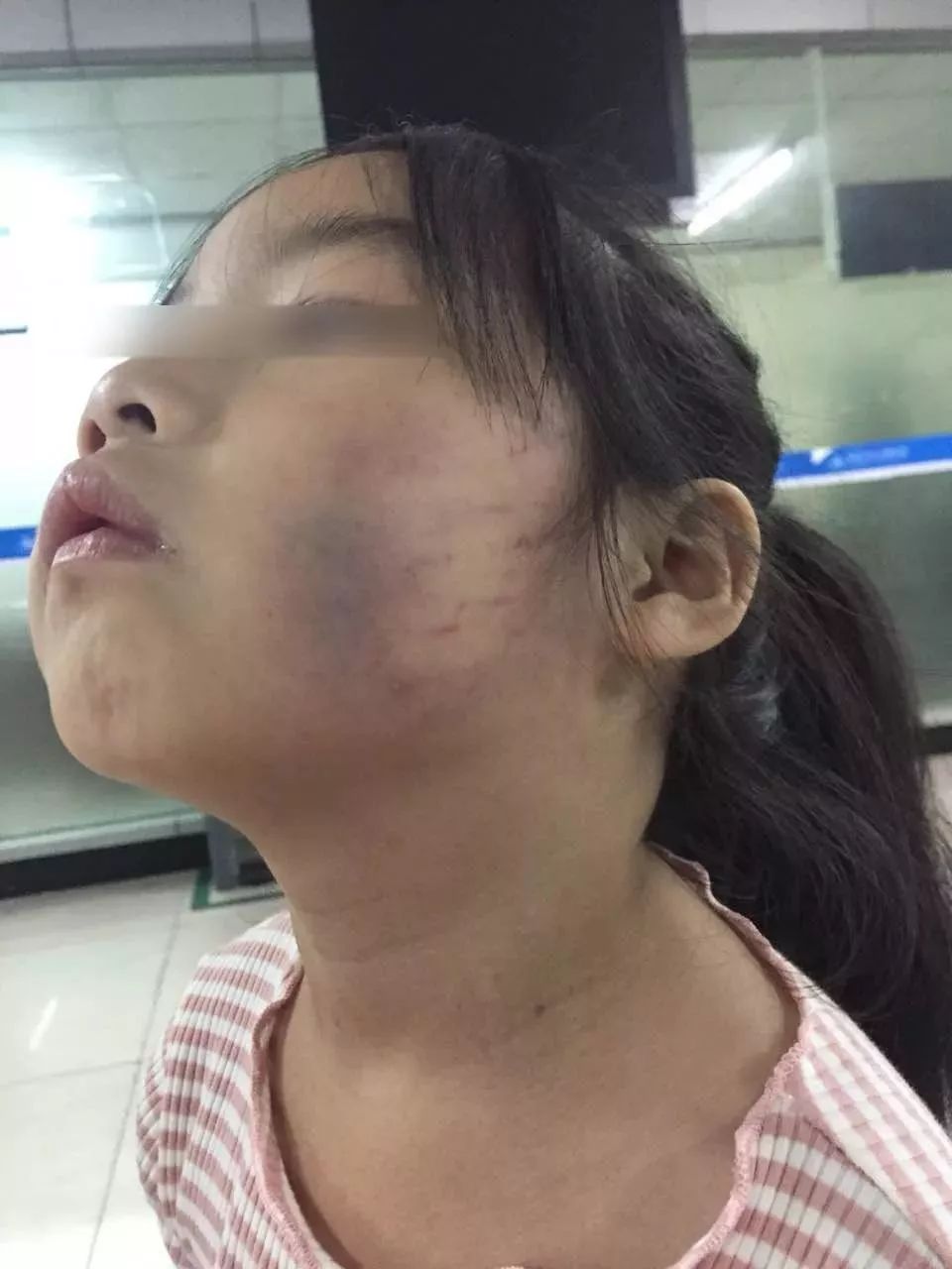 气愤东莞某幼儿园出现虐童现象4岁女童遭扇掌一脸淤青