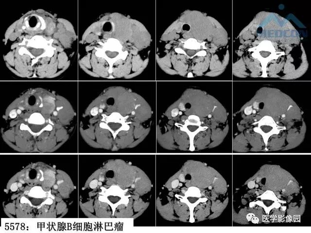 甲状腺疾病ct诊断思路与技巧 