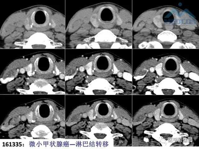 甲状腺疾病ct诊断思路与技巧 