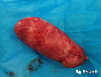 阴囊长肉瘤图片