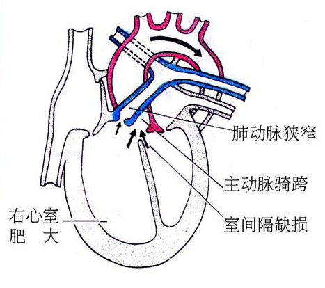 紫绀型先天性心脏病图片