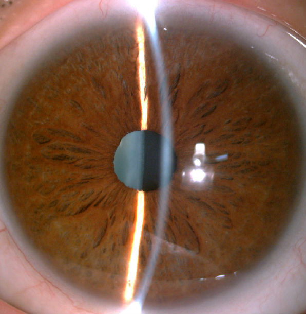 虹膜睫状体炎瞳孔放大图片
