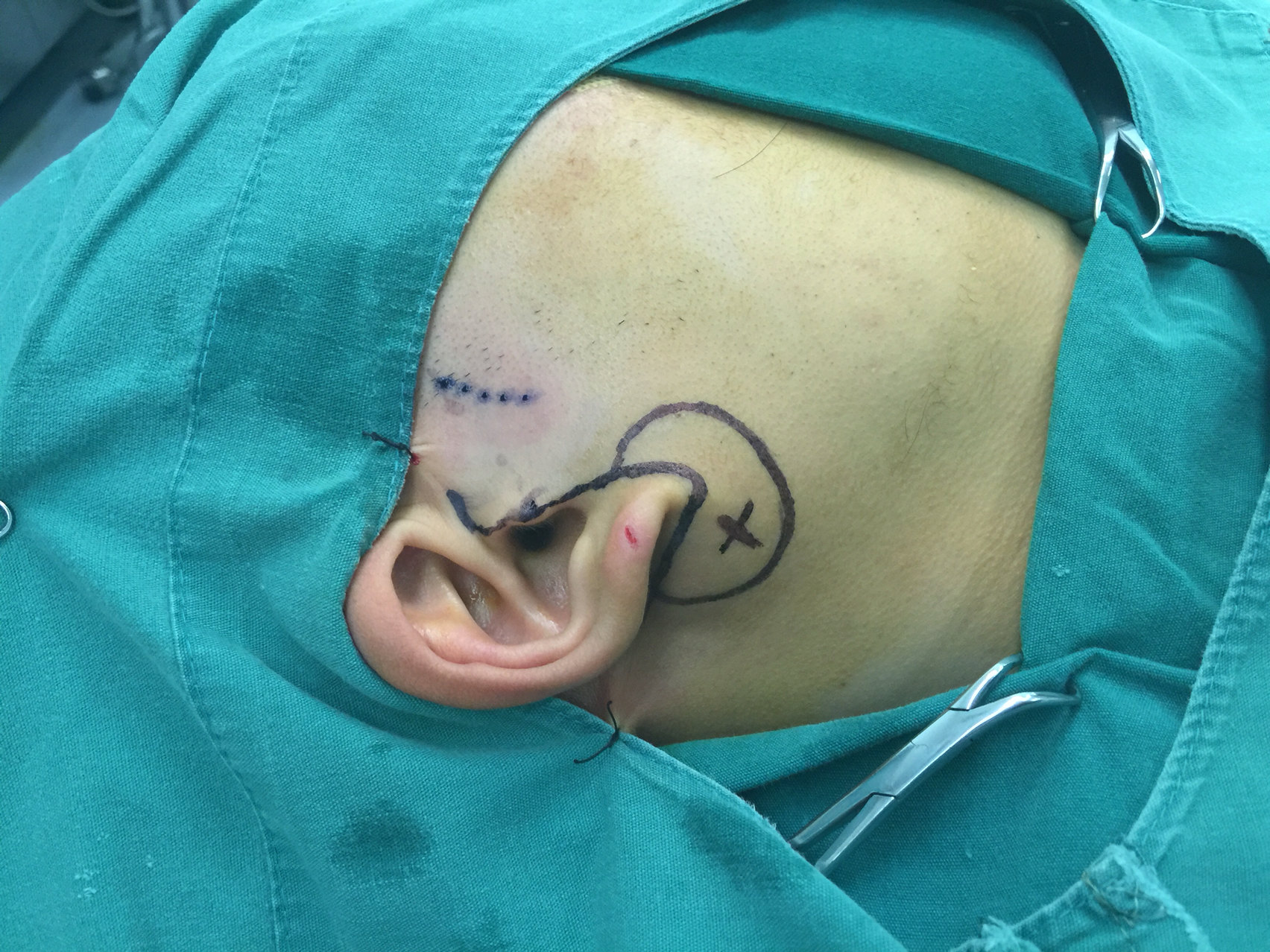 腮腺混合瘤手术疤痕图图片