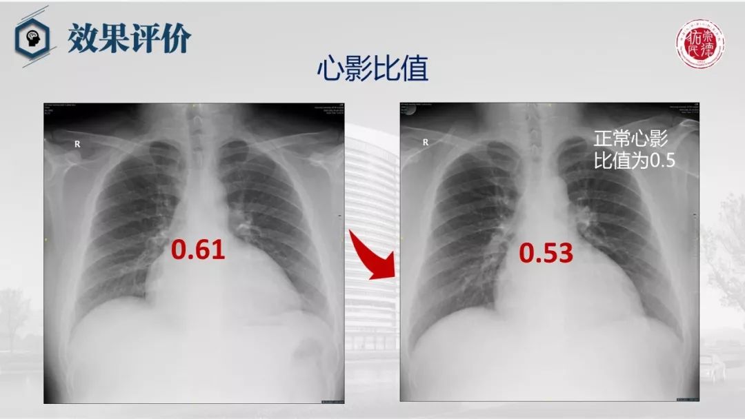 心脏康复案例分享