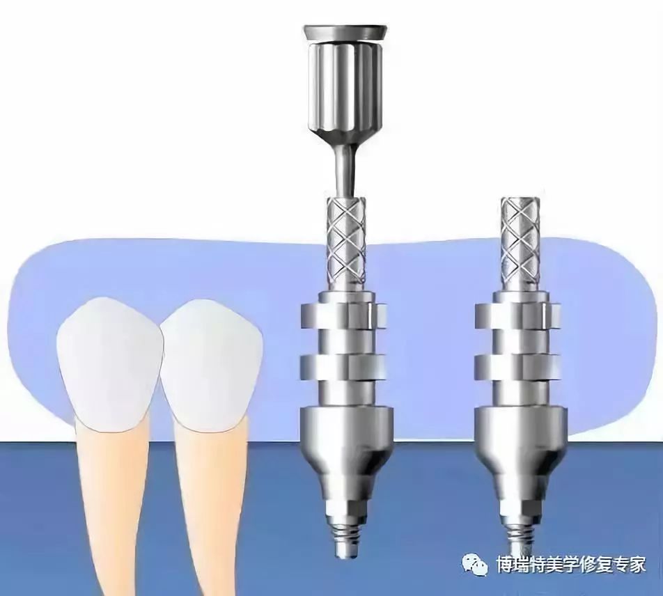 口腔種植印模及種植修復取模圖解