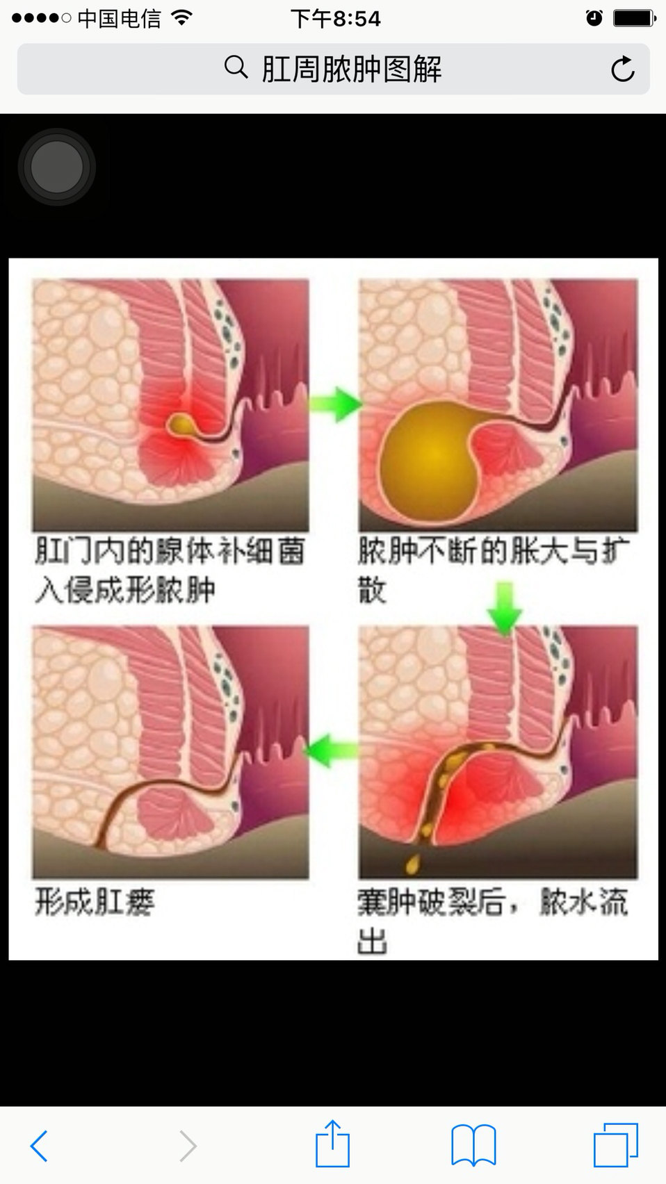 肛周脓肿早期症状图片图片