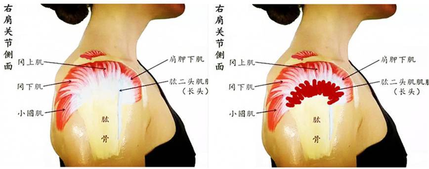 肩周炎在哪个位置图片