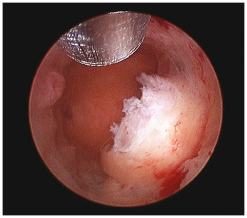 宫颈口粘膜下肌瘤图片图片