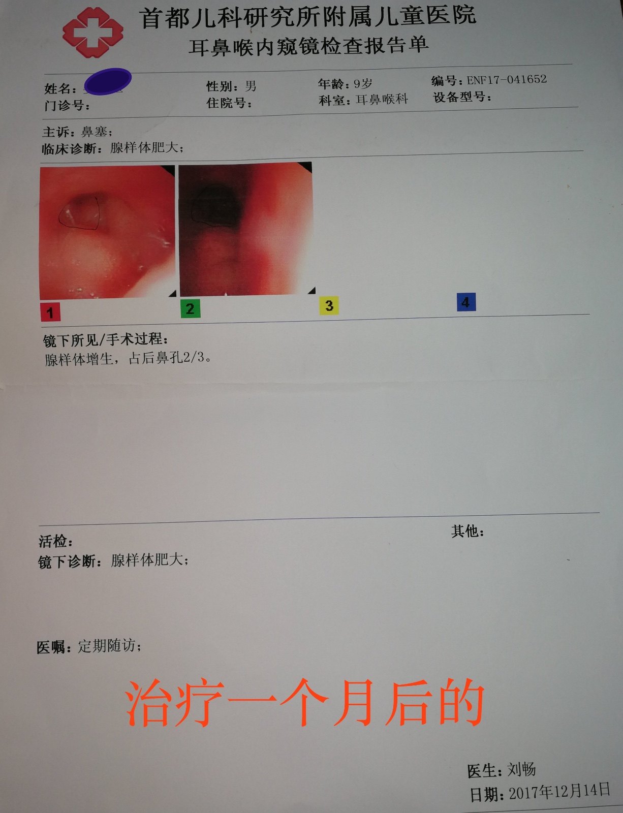 中醫藥治療腺樣體肥大的案例分享