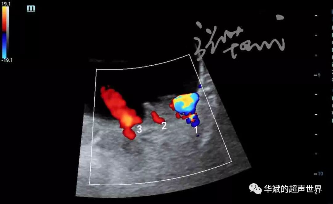 经典图片分享彩色多普勒超声下彩色信号不都是血流