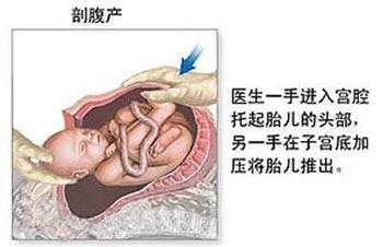剖腹产子宫恢复阶段图图片