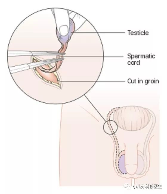 上图:睾丸切除示意图(太什么,就不放手术实图了)对于良性肿瘤的保睾术