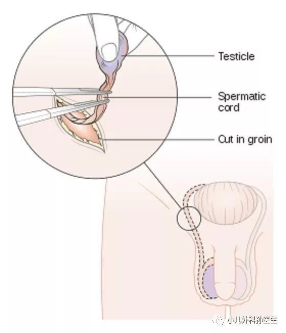 上图 睾丸切除示意图