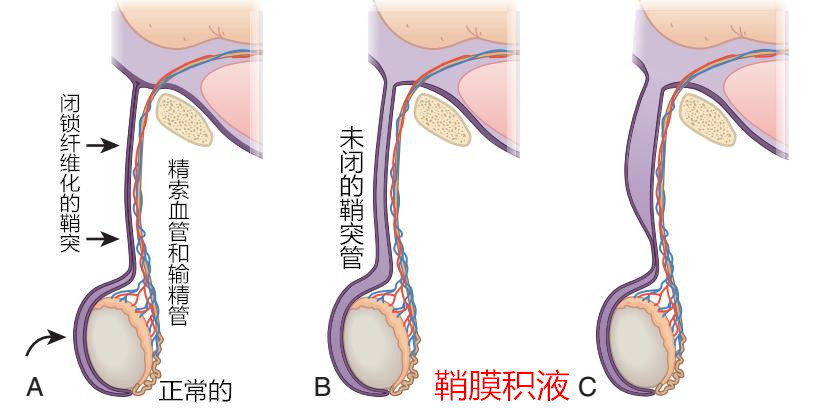 腹股沟疝b超报告模板图片