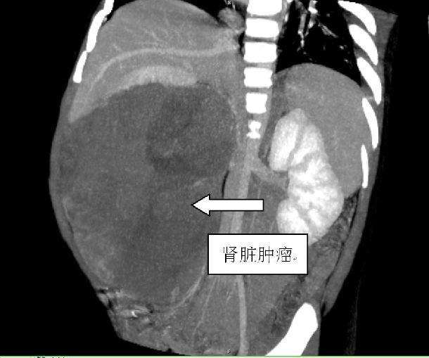 腎母細胞瘤一期手術完整切除,術後門診化療即可治癒_腫瘤