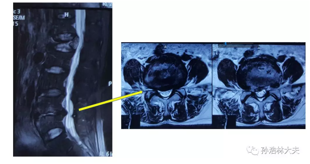 图2,术前腰椎核磁显示腰4